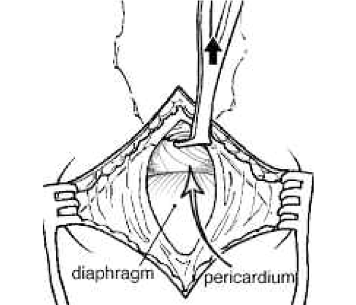 Cpt code for pericardial window