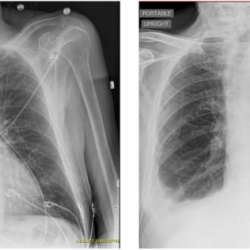 In icd-10-pcs thoracentesis right pleural effusion