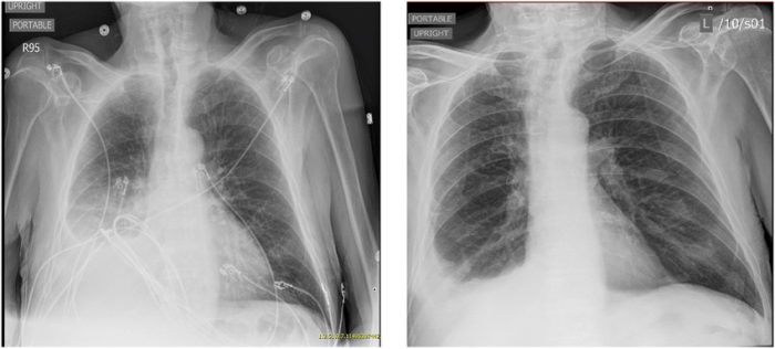 In icd-10-pcs thoracentesis right pleural effusion