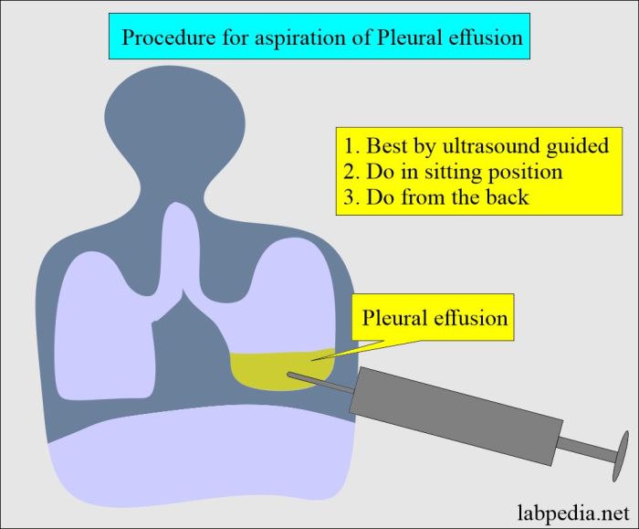 In icd-10-pcs thoracentesis right pleural effusion